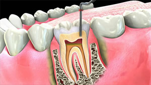 Root Canal