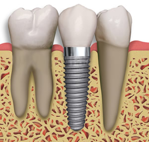 Dental Implants