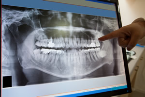 Digital Dental X-Rays