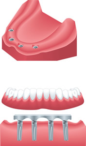 Full Mouth Rehabilitation