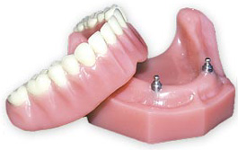 Overdenture