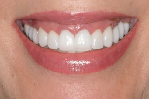 Veneers