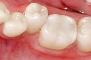 White Fillings